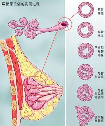 乳腺癌初期症狀及自檢方法